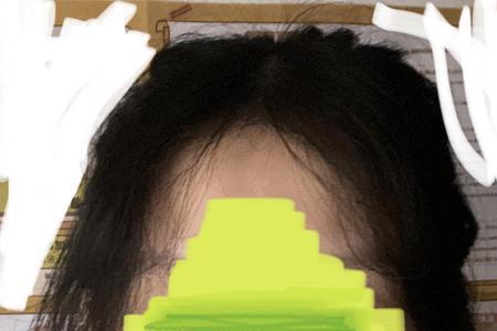 刘海中间没有头发怎么办