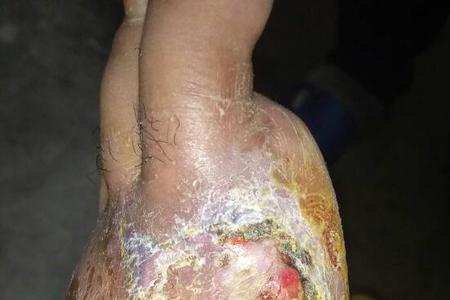 脚趾伤残等级1-10级怎么划分