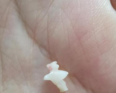 后槽牙松动怎么补救