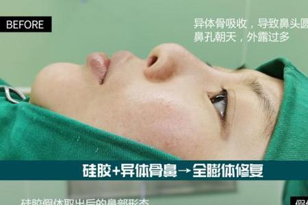 硅胶鼻子哪种形状好