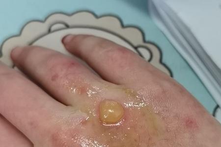 金属膜水泡多久消