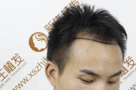 大学生m型发际线正常吗