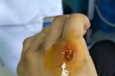 蛇咬了有三个牙印是什么蛇