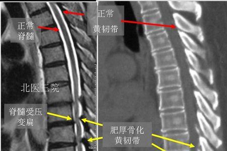 上胸椎指的是哪个位置