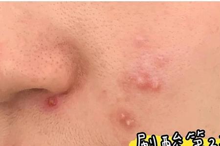 刷酸后可以用凌博士水乳吗