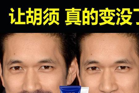 脱毛喷雾可以喷小胡子吗