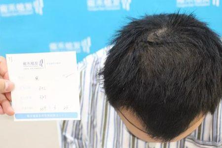 头发哪个位置长得最快