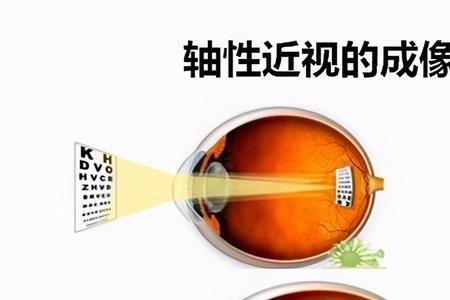 儿童眼镜轴距长有什么影响