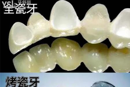 全瓷牙有多重