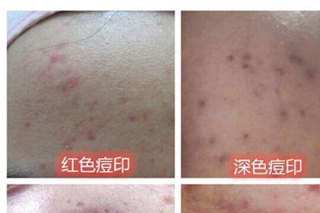 痘坑和橘皮的区别