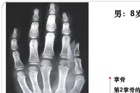 骨龄13岁男孩能长多高