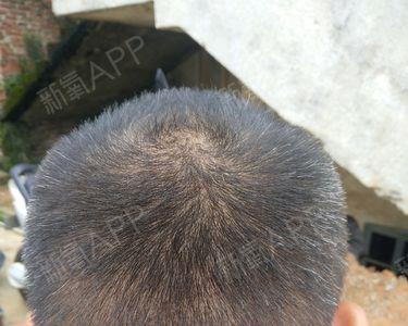 为什么前面头发多后脑勺少