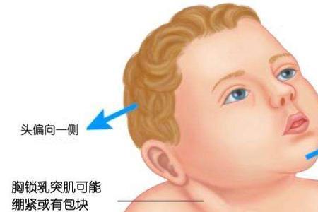 斜颈可以考驾照吗
