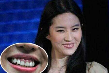 为什么有些人笑又露齿