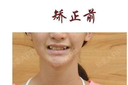 男孩儿几岁扎大牙