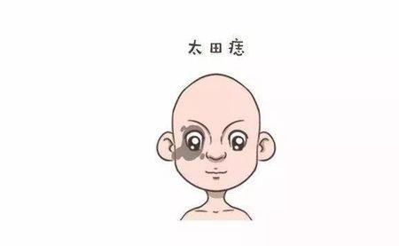 为什么宝宝身上的痣和大人一样