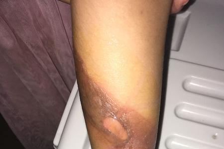 身体疤痕累计多少够十级伤残