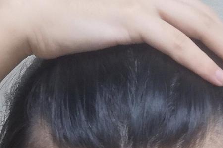 16岁女生头发前面秃顶怎么办