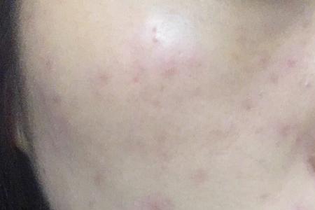 dw粉底液闷痘长闭口怎么办