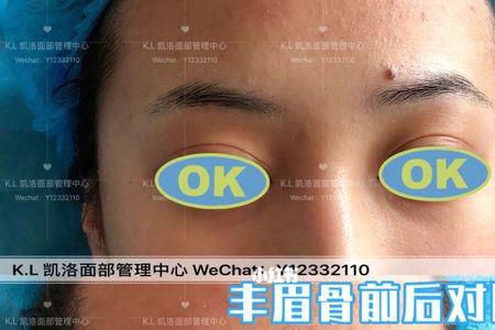 眉弓和眉骨区别