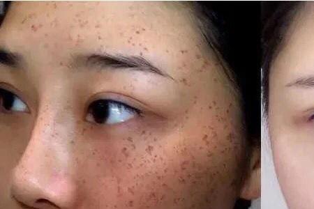 黑色素堆积的地方怎么才能洗白