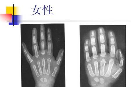 骨龄积分法怎么计算骨龄