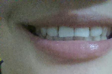 左边的一颗牙子发酸是什么原