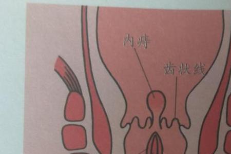 古代痔疮叫什么名字