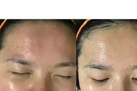 刷酸和微针哪个先