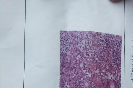 去分化和低分化的区别