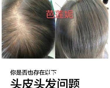 头发生得高好还是低好