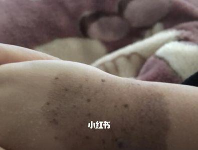 手上有胎记能当兵吗
