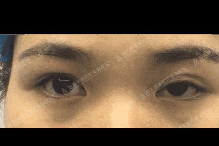 亚洲人眼睑高度