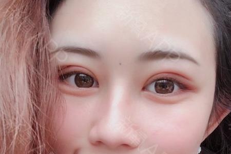 双眼皮两公分好还是三公分好