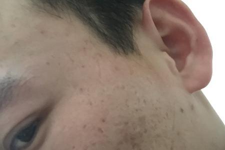 男生一脸痘坑相亲可能成功吗