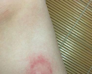 什么虫子喜欢咬手腕下方