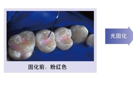 窝沟封闭用流体树脂可以吗