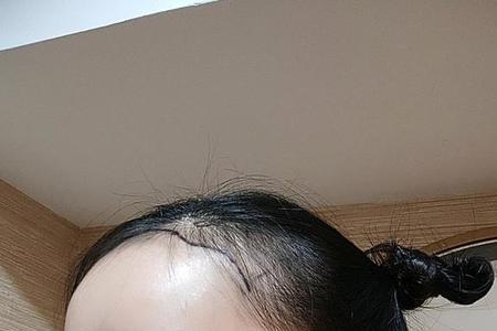 中年女人秃头还能长头发吗