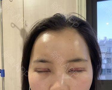 伽玛刀多久能拆纱布