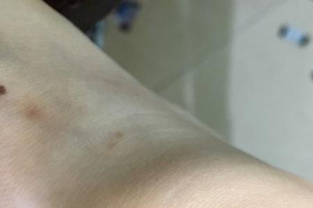 香瓜被虫咬了洞怎么治