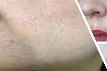 脸色苍白和变白的区别