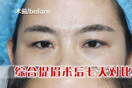 提眉后眼睛和眉毛距离近怎么办