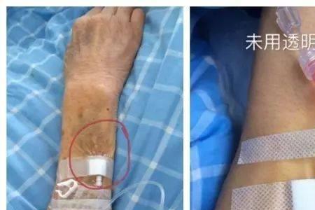 留置针固定的几种正确方法