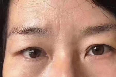 三十多岁做提眉的人多吗