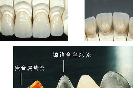烤瓷牙是什么
