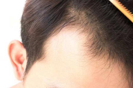 为什么以前的人头发很多