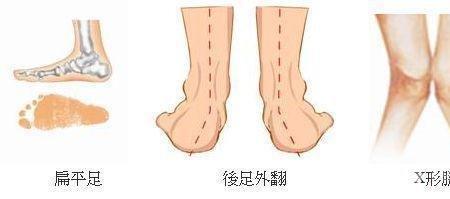 扁平足能穿平底鞋吗