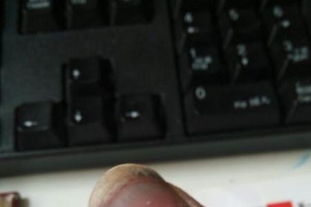砸伤手指的赔偿标准