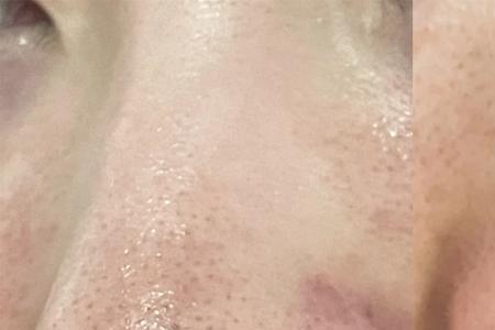 水杨酸细致毛孔霜多久洗掉
