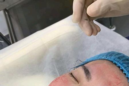 fue和微针啥区别
